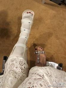 腿上缠绷带的图片,绷带见证的坚韧与希望  第2张