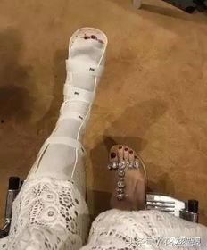 腿上缠绷带的图片,绷带见证的坚韧与希望  第3张